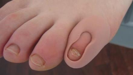 orthoplastie pédicure podologue cergy othoplastie pédicure podologue cergy